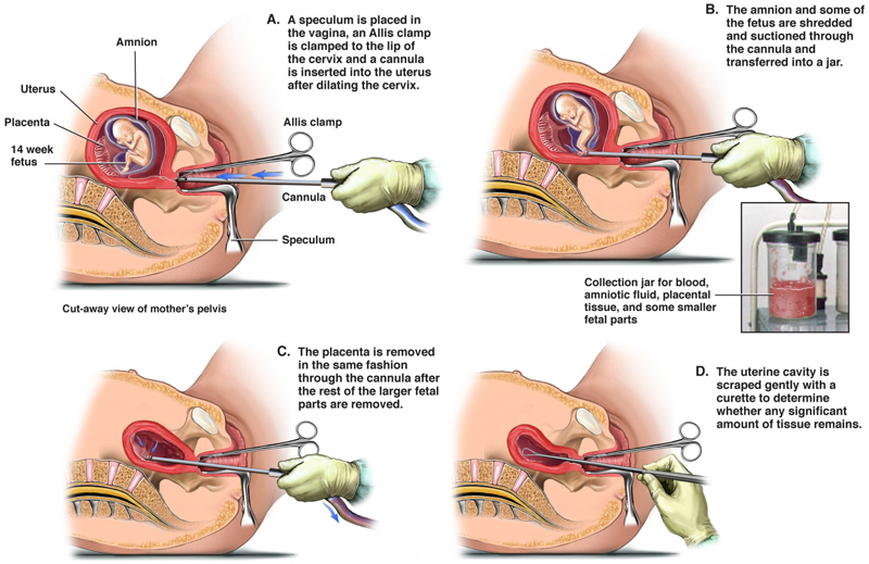 suctionabortion14weekbabyinwomb